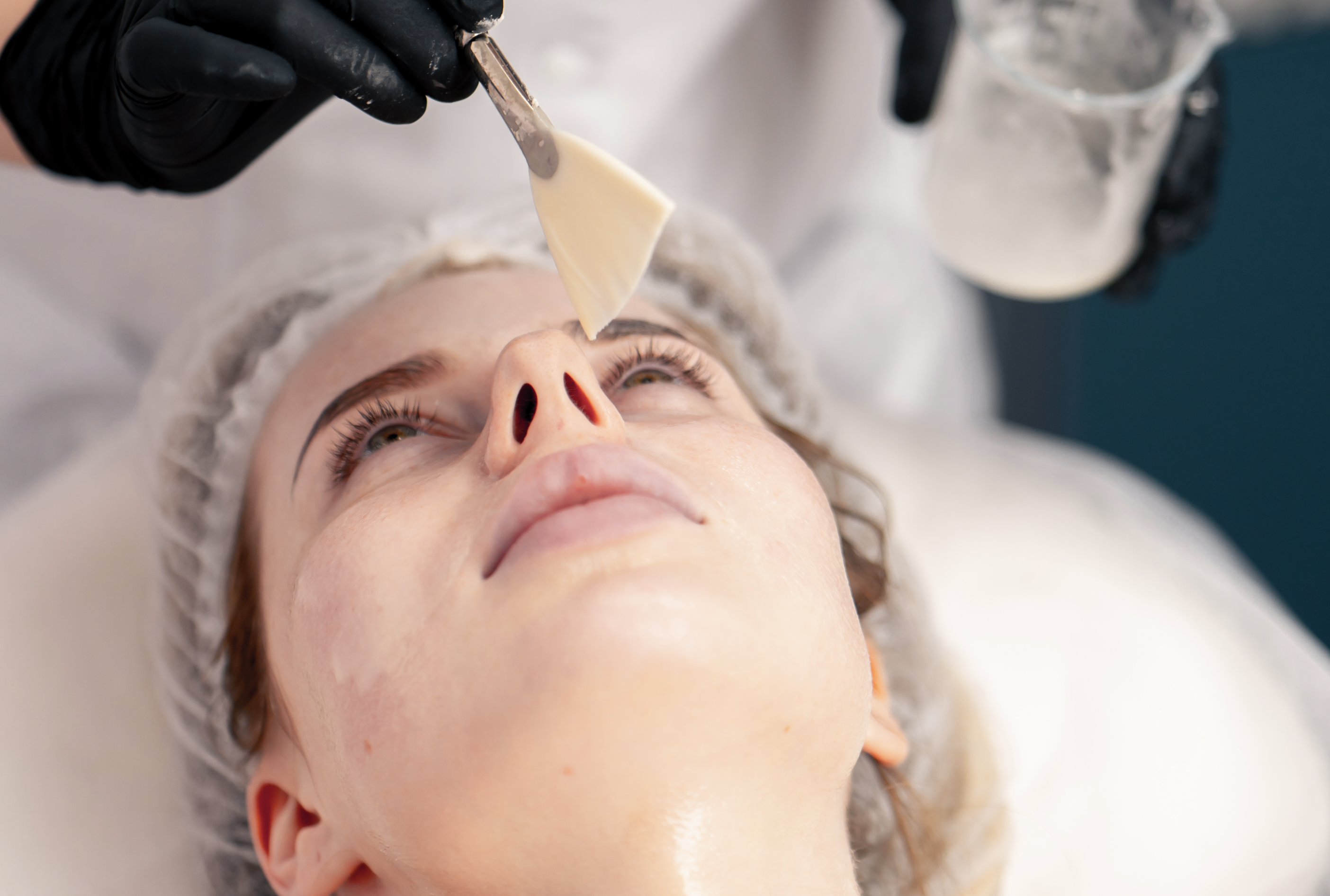 Chemical Peel